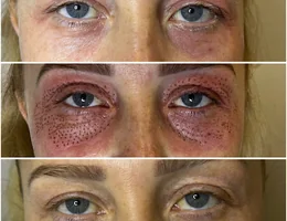 Épilation au laser O’BEAUTY ATELIER